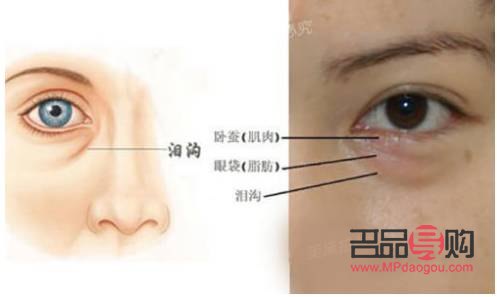 <h3>眶隔释放眼袋整形术的风险性探讨</h3>