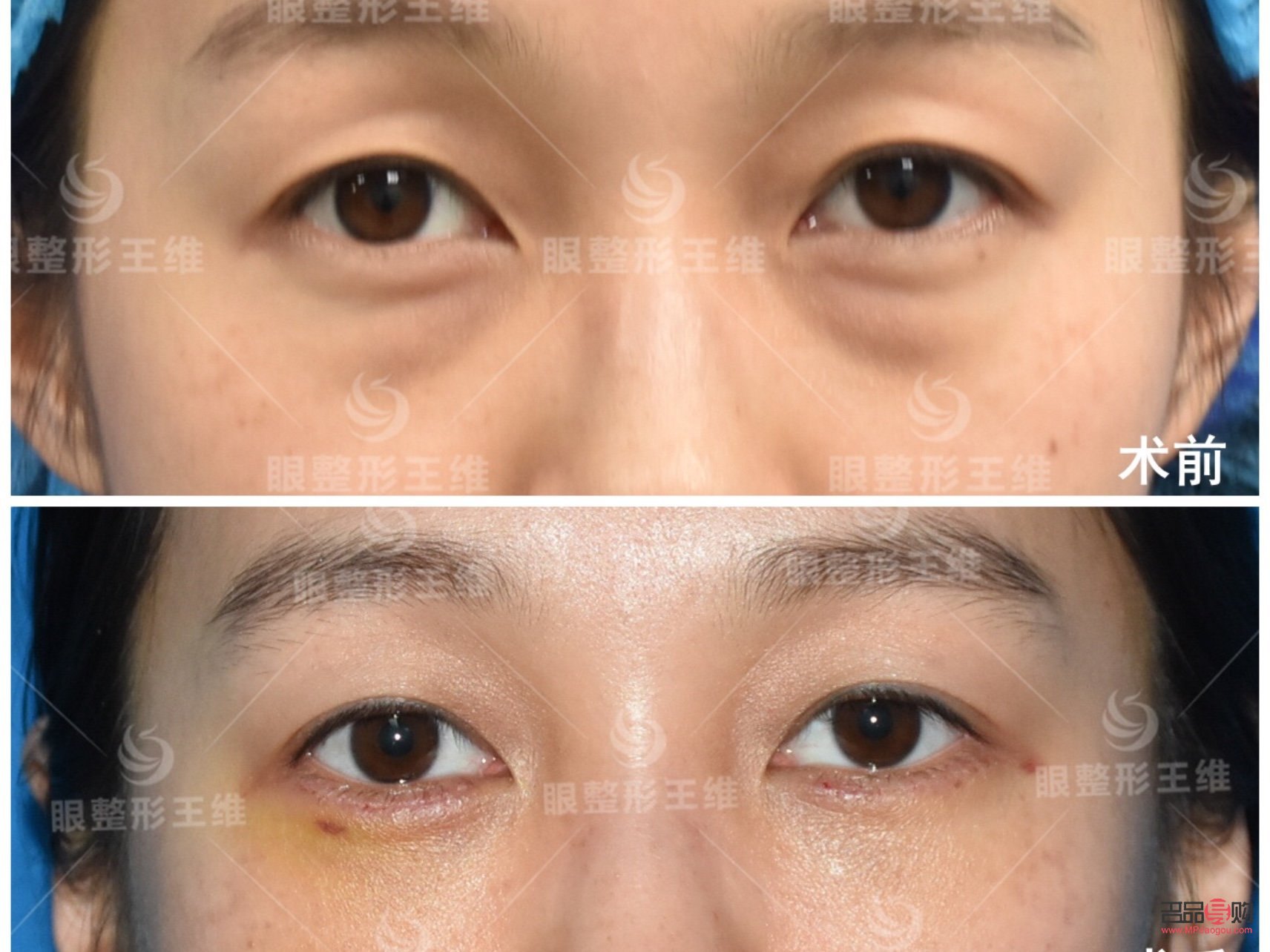 <h3>眶隔释放眼袋整形术的风险性探讨</h3>