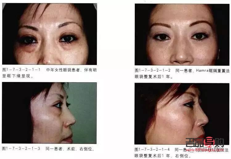 眶隔释放眼袋整形术的风险性探讨