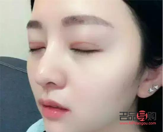 成功的双眼皮闭眼痕迹(双眼皮闭眼痕迹太重了)