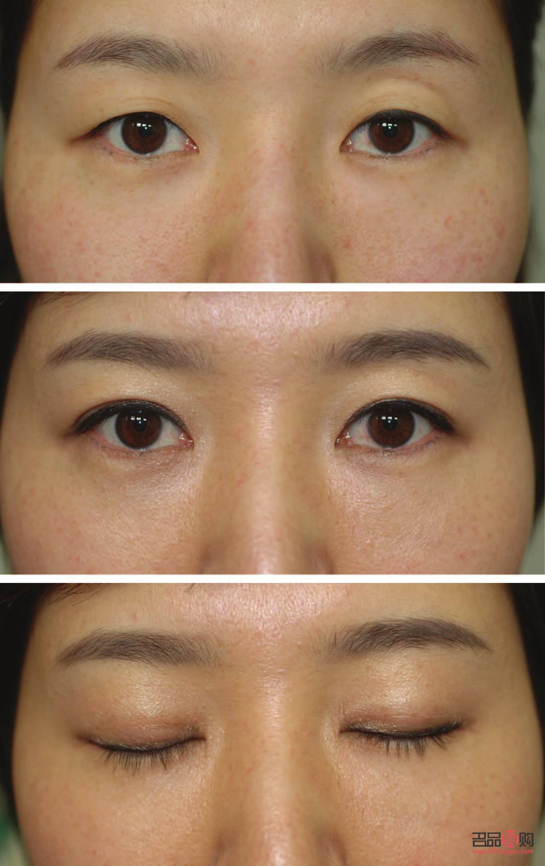 双眼皮术后疤痕图片(双眼皮术后疤痕图片大全)