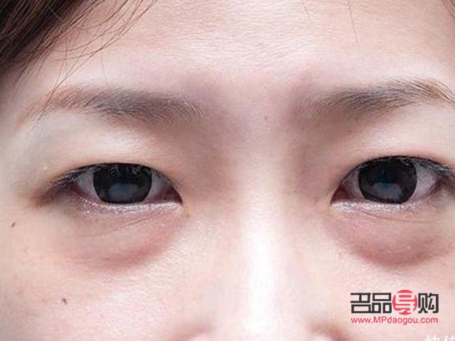 去眼袋的注意事项有哪些(去眼袋的注意事项有哪些呢)