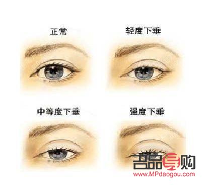 先天性眼皮下垂能治好吗图片(先天性眼皮下垂能治好吗图片视频)