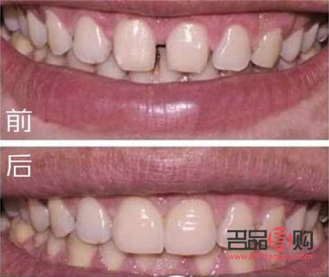 美容冠效果怎么样(美容冠好不好)