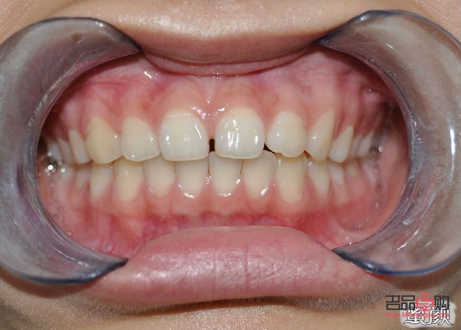 美容冠效果怎么样(美容冠好不好)