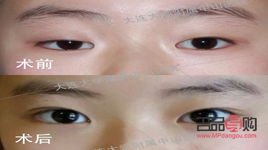 <h1>青少年眼睑下垂：原因、影响与解决方案</h1>