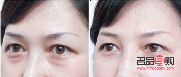 什么去眼袋效果最好(什么去眼袋效果最好护肤品)