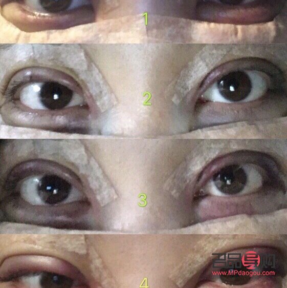 <h3>割双眼皮手术对眼睛的可能伤害</h3>