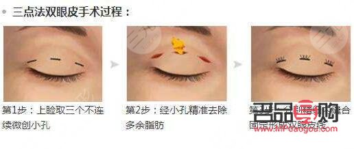 <h3>割双眼皮手术对眼睛的可能伤害</h3>