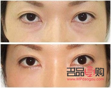 怎么样消除黑眼圈黑眼袋(怎么样消除黑眼圈黑眼袋最有效)