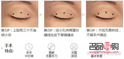 埋线双眼皮和割双眼皮哪种好(双眼皮技术不开刀不埋线) 埋线双眼皮和割双眼皮哪种好(双眼皮技术不开刀不埋线)