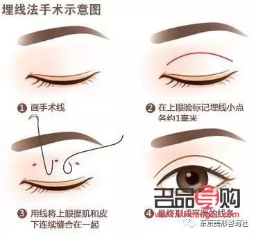 埋线双眼皮和割双眼皮哪种好(双眼皮技术不开刀不埋线)