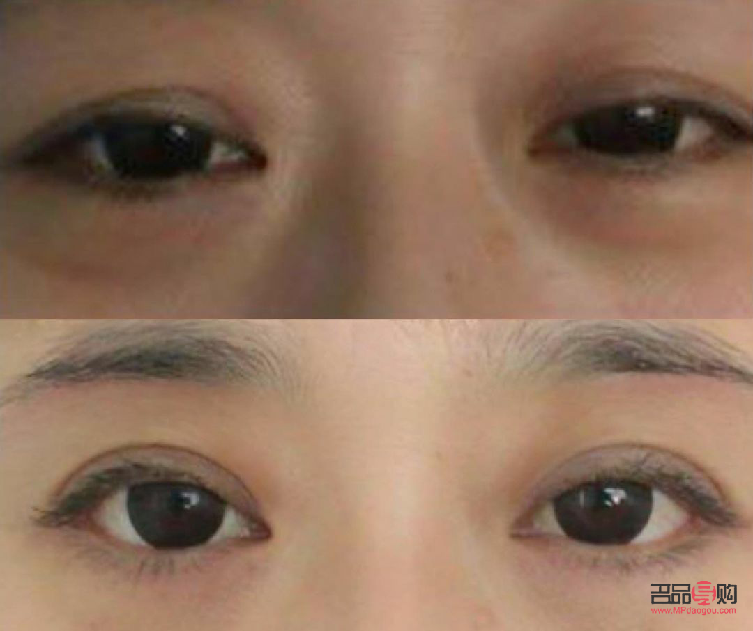 经常贴双眼皮贴，眼皮真的会松弛吗？