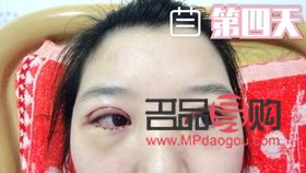 <h3>月经期做双眼皮手术，风险与后果需知</h3>