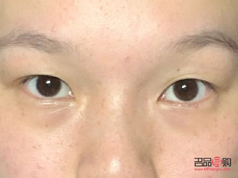 <h3>内双肿眼泡的消除秘诀</h3> <h3>内双肿眼泡的消除秘诀</h3>