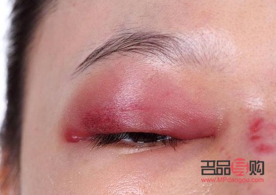 结膜炎上眼皮肿怎么办(结膜炎上眼皮肿怎么办图面)