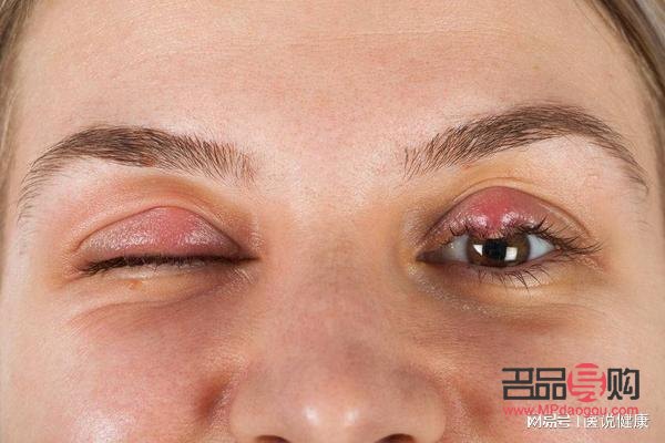 结膜炎上眼皮肿怎么办(结膜炎上眼皮肿怎么办图面)