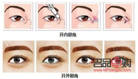 开眼角要多少钱大概(开眼角多少钱?)