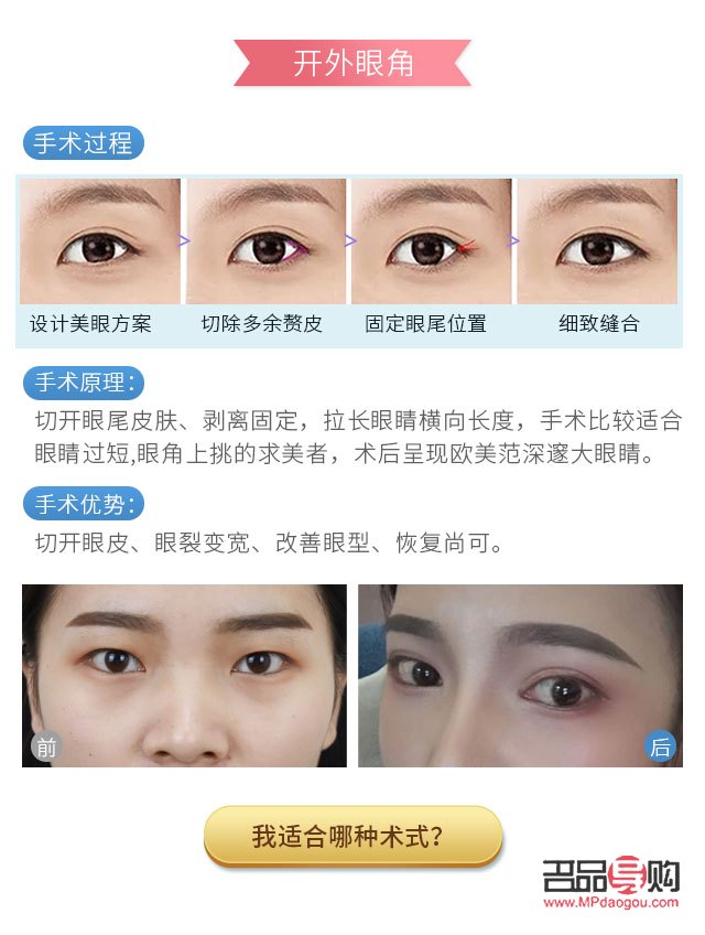 开眼角要多少钱大概(开眼角多少钱?)