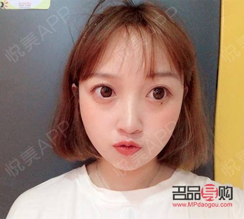 双眼皮老了下垂怎么办(双眼皮老了下垂怎么办呢)