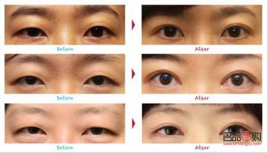 双眼皮老了下垂怎么办(双眼皮老了下垂怎么办呢)