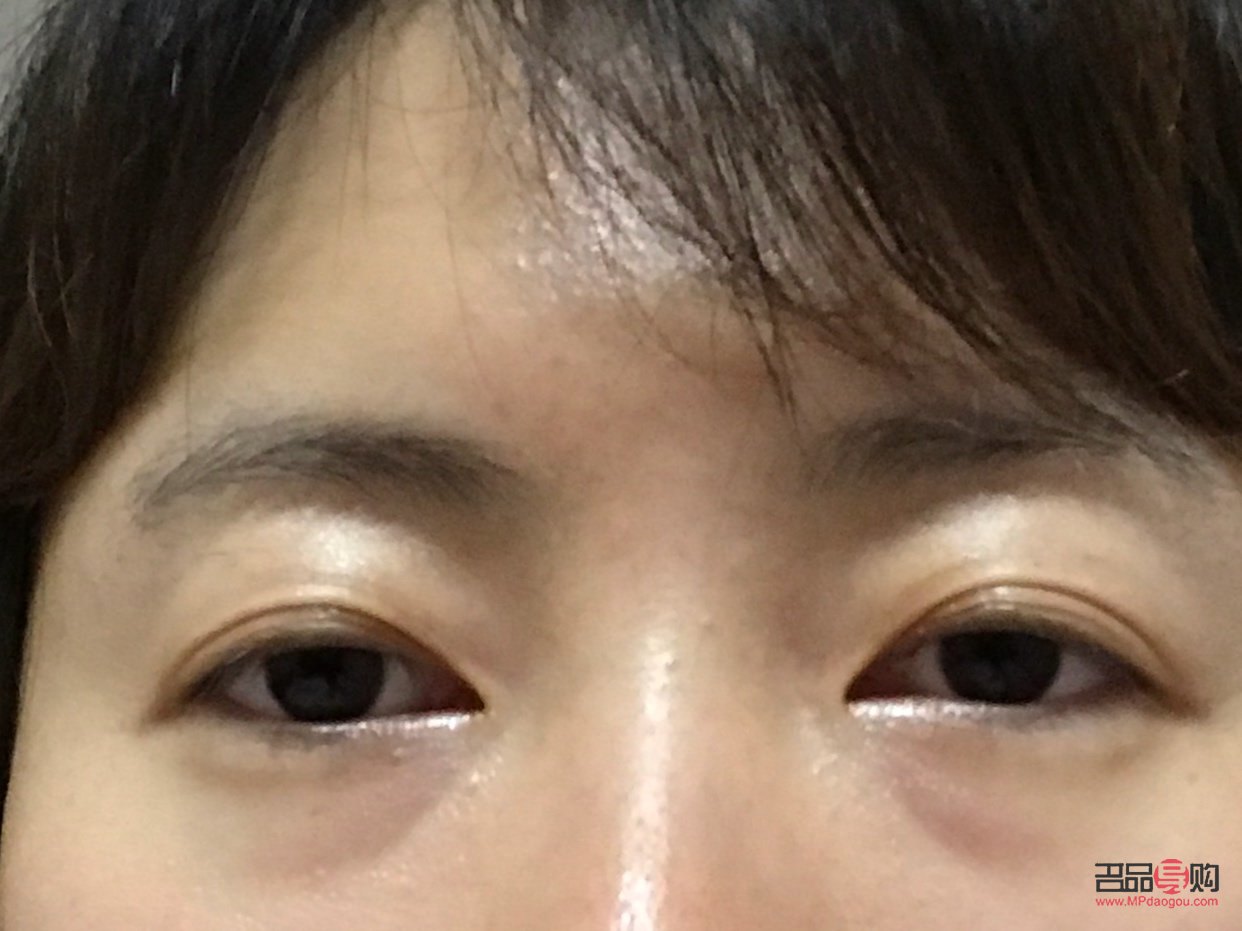 眼袋凹陷怎么恢复饱满(眼袋凹陷怎么恢复饱满不手术)