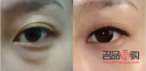 眼袋凹陷怎么恢复饱满(眼袋凹陷怎么恢复饱满不手术)