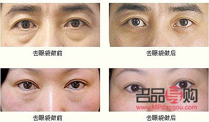 无痕眼袋手术及其费用详解