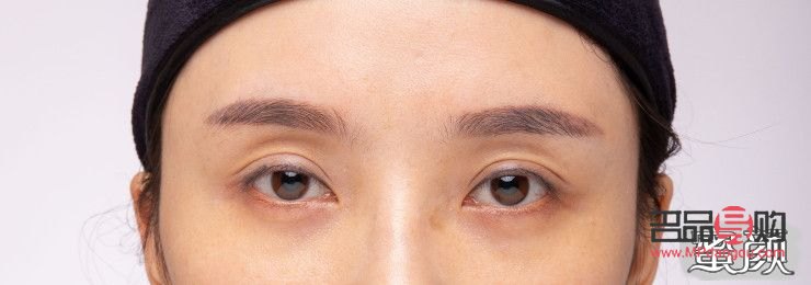 黑眼圈眼眶凹陷怎么恢复饱满呢(黑眼圈眼眶凹陷怎么恢复饱满呢图片) 黑眼圈眼眶凹陷怎么恢复饱满呢(黑眼圈眼眶凹陷怎么恢复饱满呢图片)
