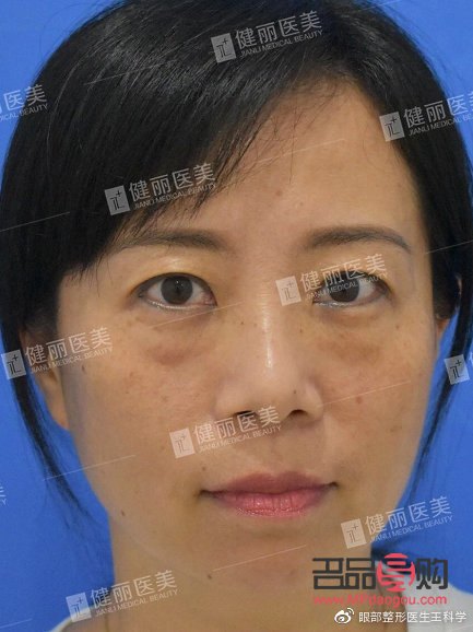 <h3>四十多岁，做眼袋手术是否合适？</h3>