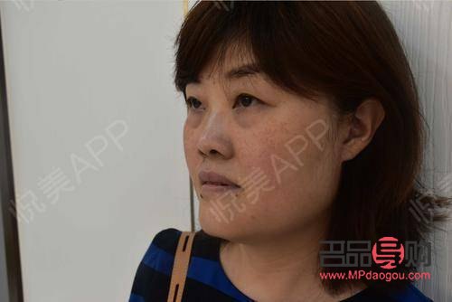 <h3>四十多岁，做眼袋手术是否合适？</h3>