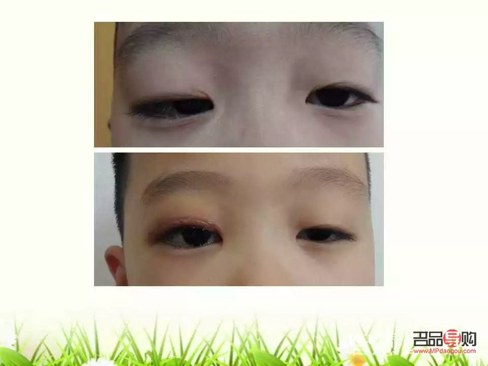 眼角下垂有什么办法可以调整的(眼角下垂有什么办法可以调整的小孩)