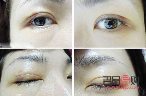 双眼皮割深了的处理方法与注意事项