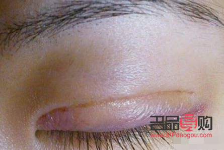 双眼皮手术疤痕多久能恢复自然(双眼皮手术疤痕多久消失)