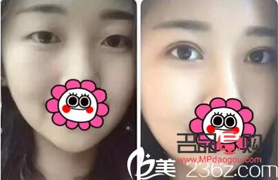 双眼皮修复成功案例(双眼皮修复成功案例图片)