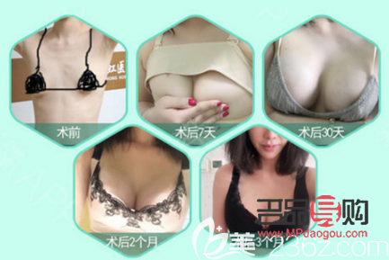 双眼皮修复成功案例(双眼皮修复成功案例图片)