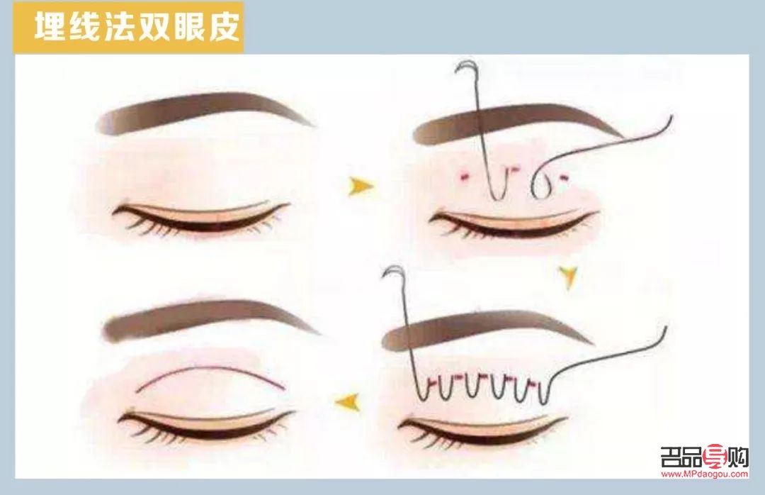 <h3>修复埋线双眼皮宽度不一的方法与注意事项</h3> <h3>修复埋线双眼皮宽度不一的方法与注意事项</h3>