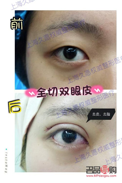 割双眼皮对以后会有什么影响嘛(割双眼皮对以后会有什么影响嘛图片) 割双眼皮对以后会有什么影响嘛(割双眼皮对以后会有什么影响嘛图片)