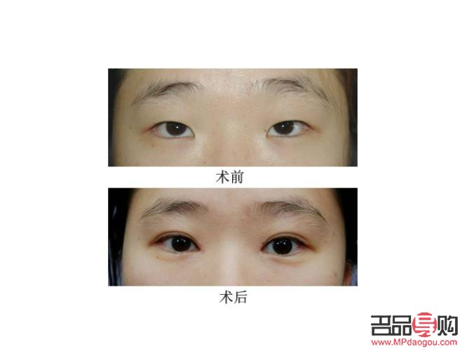 割双眼皮对以后会有什么影响嘛(割双眼皮对以后会有什么影响嘛图片)