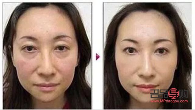 先天性肿眼泡怎么消除图片(先天性肿眼泡怎么消除图片大全)