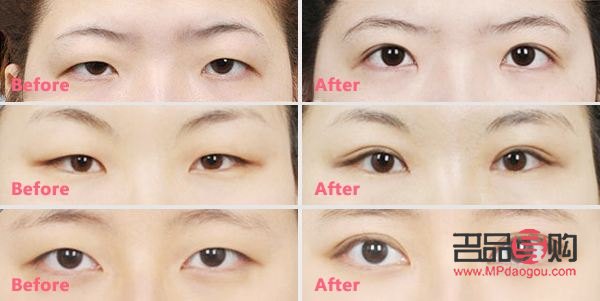 先天性肿眼泡怎么消除图片(先天性肿眼泡怎么消除图片大全)