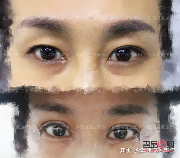 全切双眼皮和眼综合区别大吗(全切双眼皮和眼综合区别大吗多少钱)