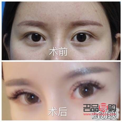 全切双眼皮和眼综合区别大吗(全切双眼皮和眼综合区别大吗多少钱)