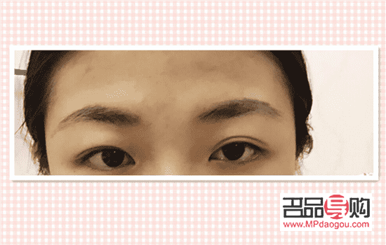 双眼皮恢复期照片(双眼皮恢复的照片) 双眼皮恢复期照片(双眼皮恢复的照片)