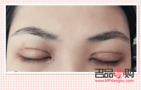 双眼皮恢复期照片(双眼皮恢复的照片)