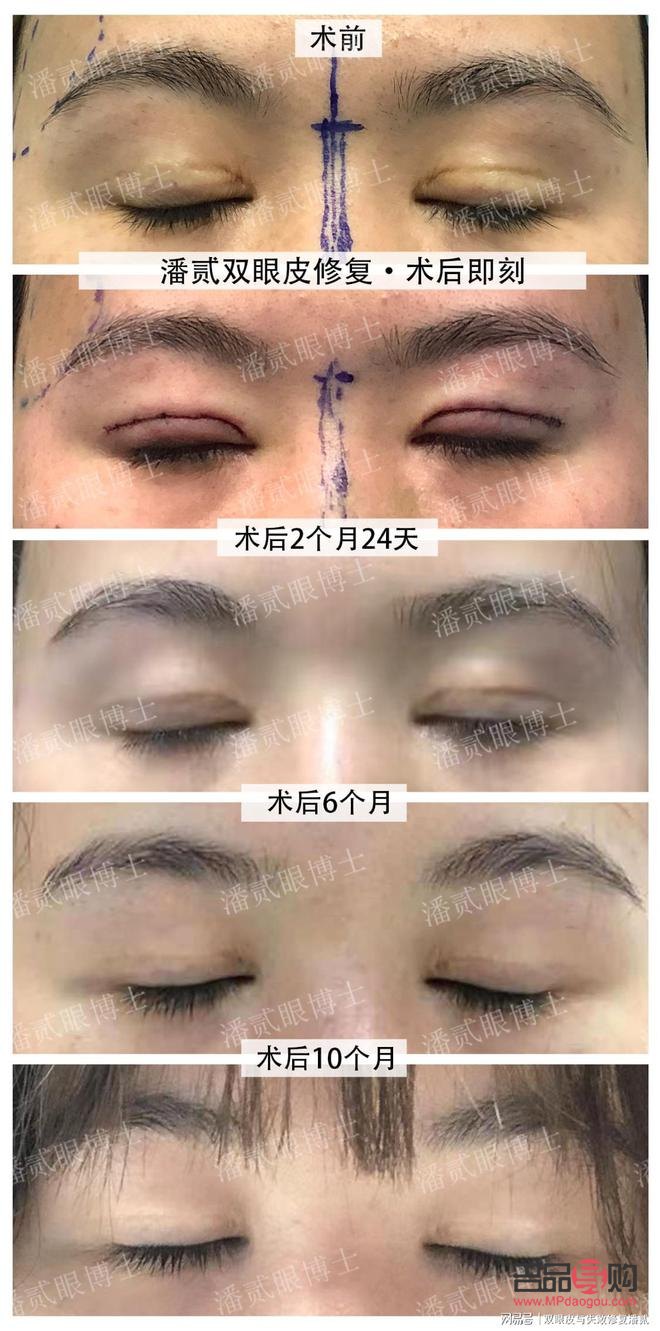 砭石眼部按摩恢复视力(砭石眼部按摩恢复视力有效果吗)