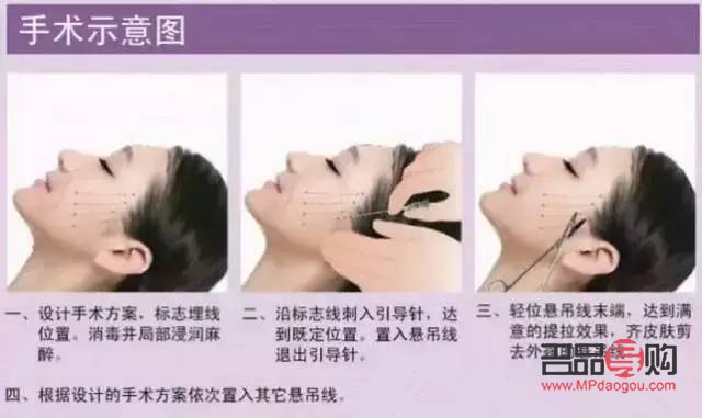 <h3>线雕双眼皮与埋线双眼皮的区别详解</h3>