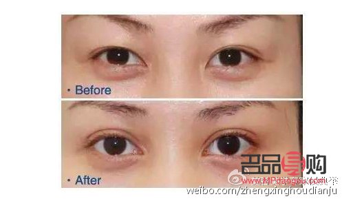 <h1>双眼皮魅力之谜:外双与内双边的独特组合</h1> <h1>双眼皮魅力之谜:外双与内双边的独特组合</h1>