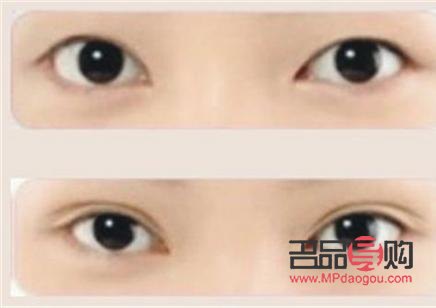 <h3>内双想割双眼皮，哪种手术方法更适合？</h3>
