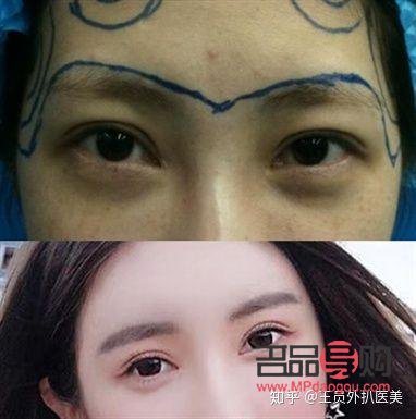 如何应对一个眼皮单一个眼皮双的困扰？